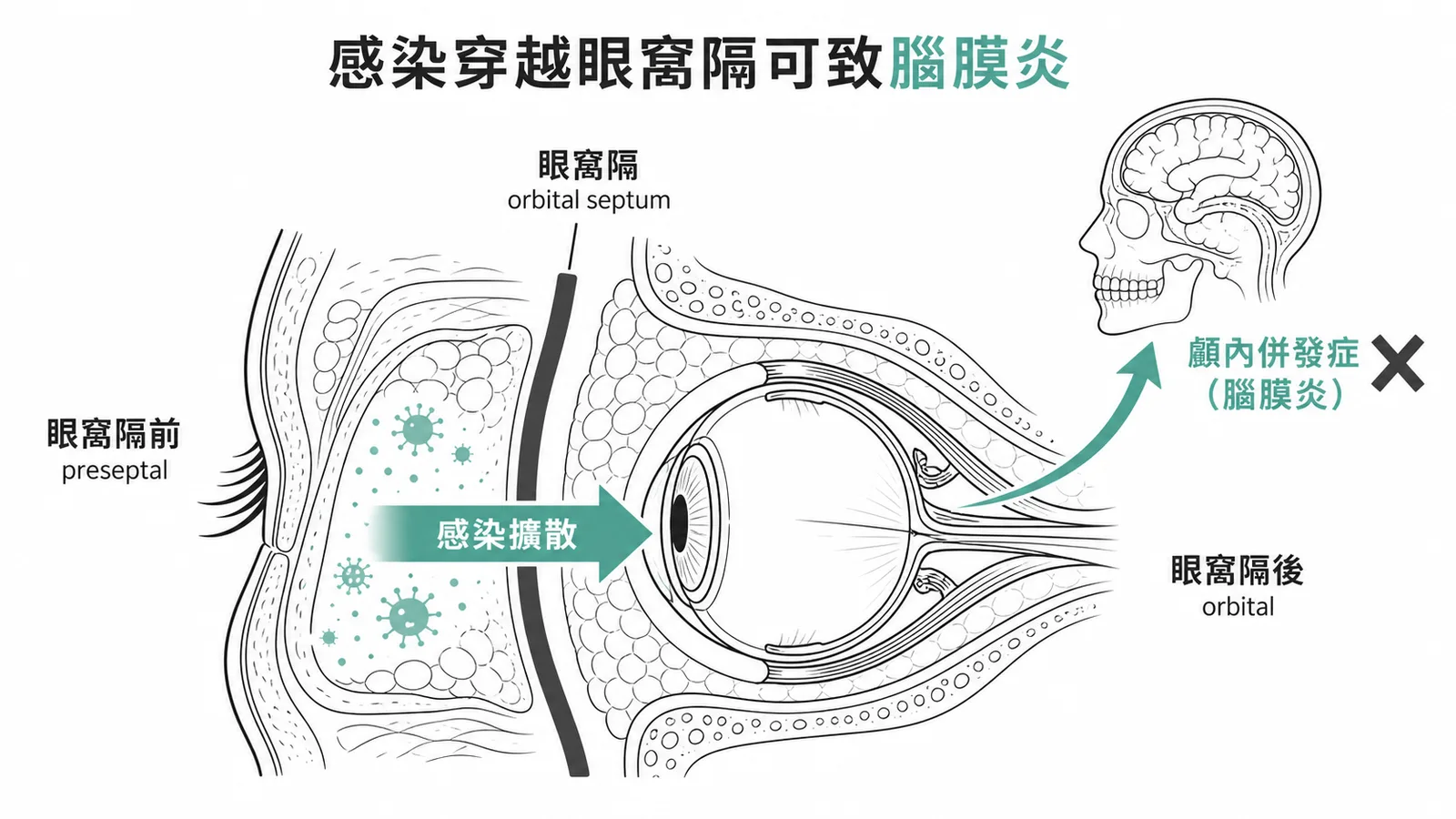 眼窩隔前後感染擴散示意圖:感染穿越眼窩隔可致顱內併發症