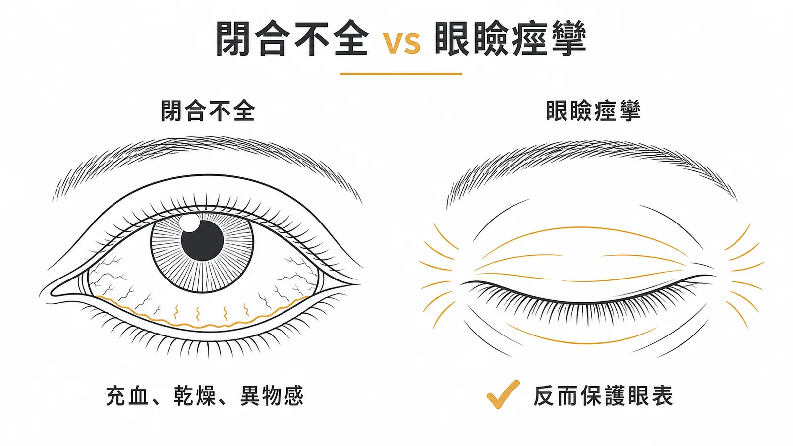 眼瞼閉合不全導致暴露性角膜炎，眼瞼痙攣反而保護眼表