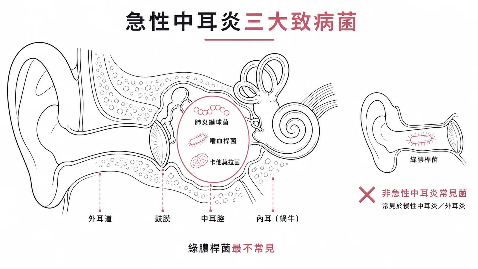 急性中耳炎三大致病菌與綠膿桿菌的區別
