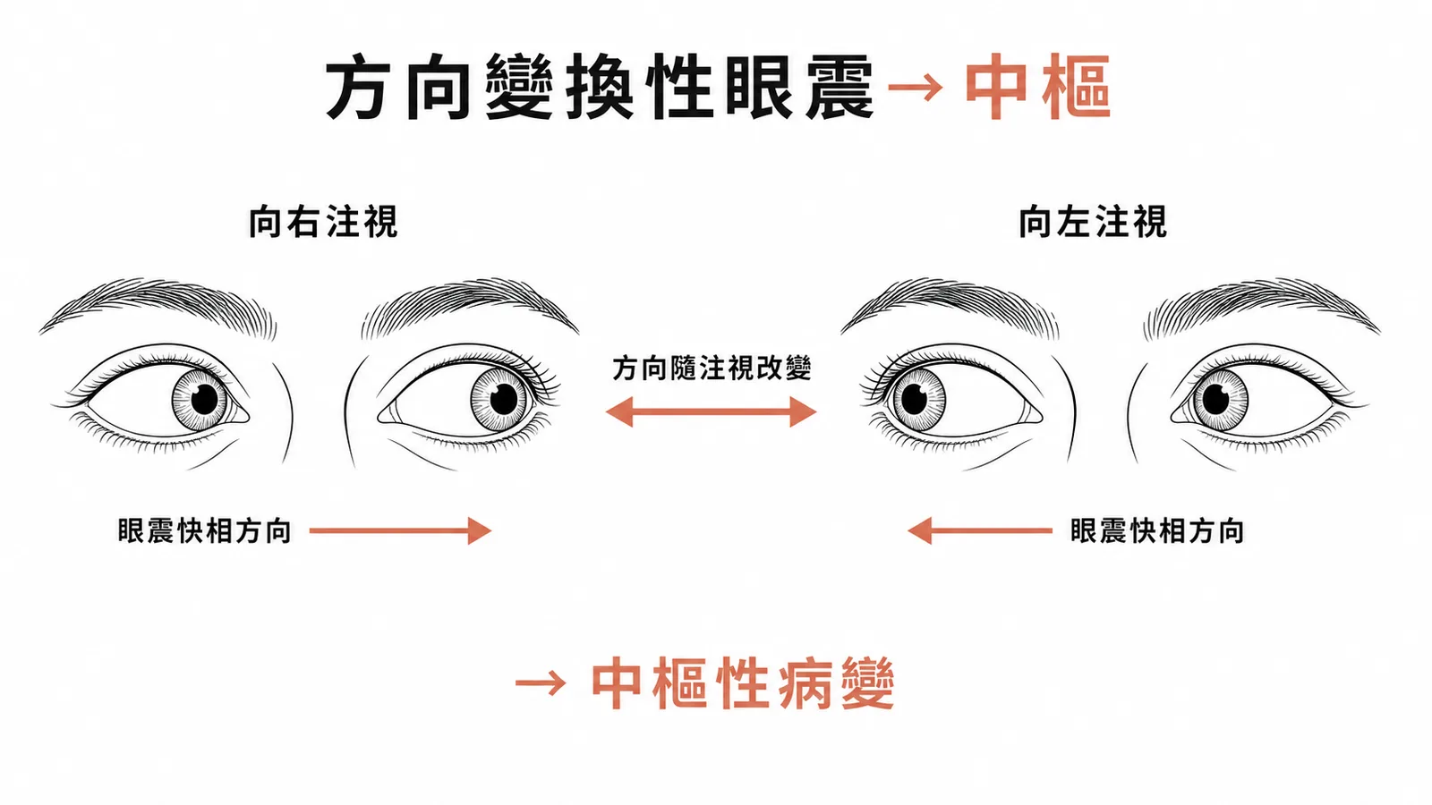 方向變換性眼震為中樞性病變的典型特徵