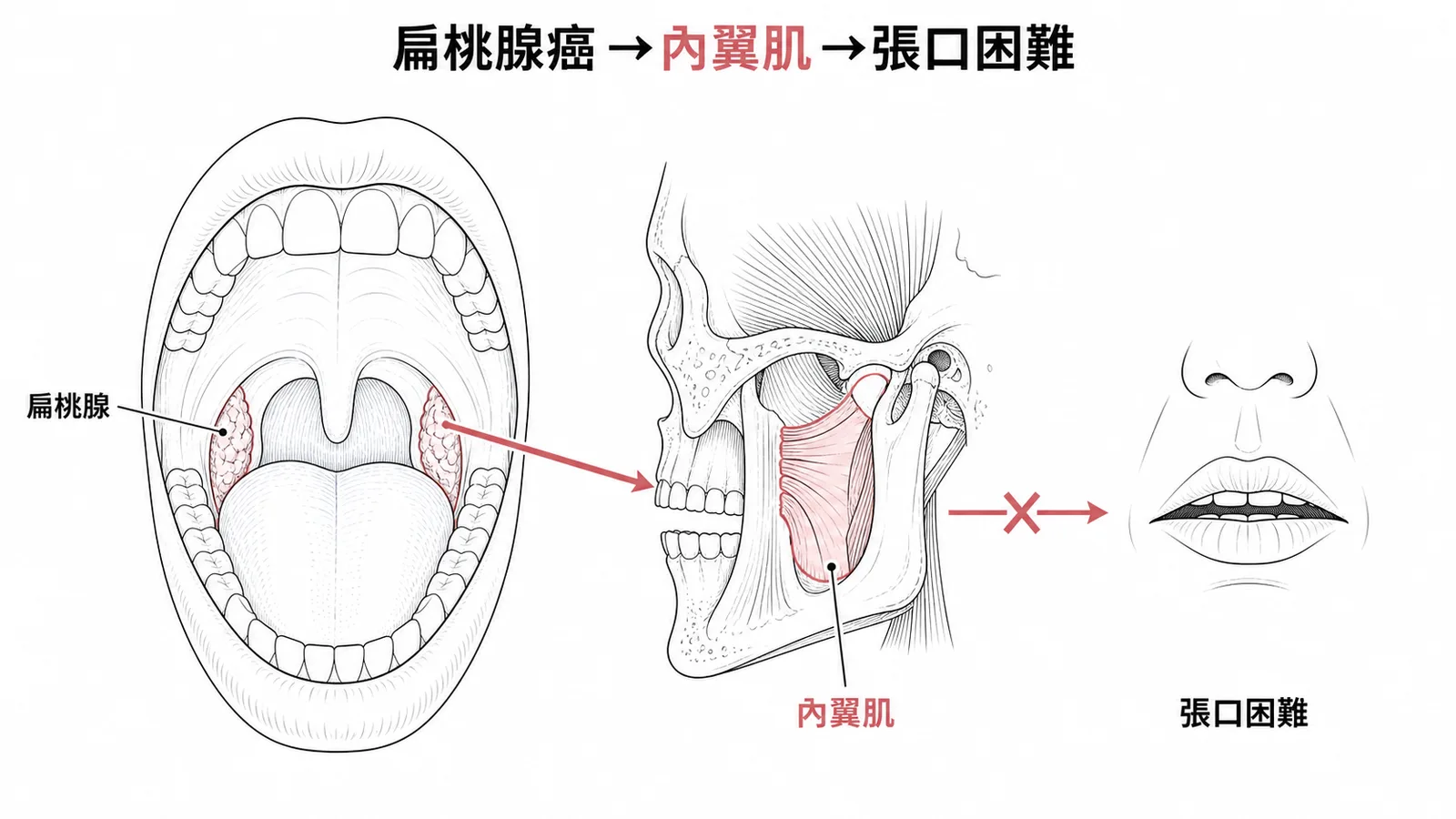 扁桃腺癌最易侵犯內翼肌導致張口困難
