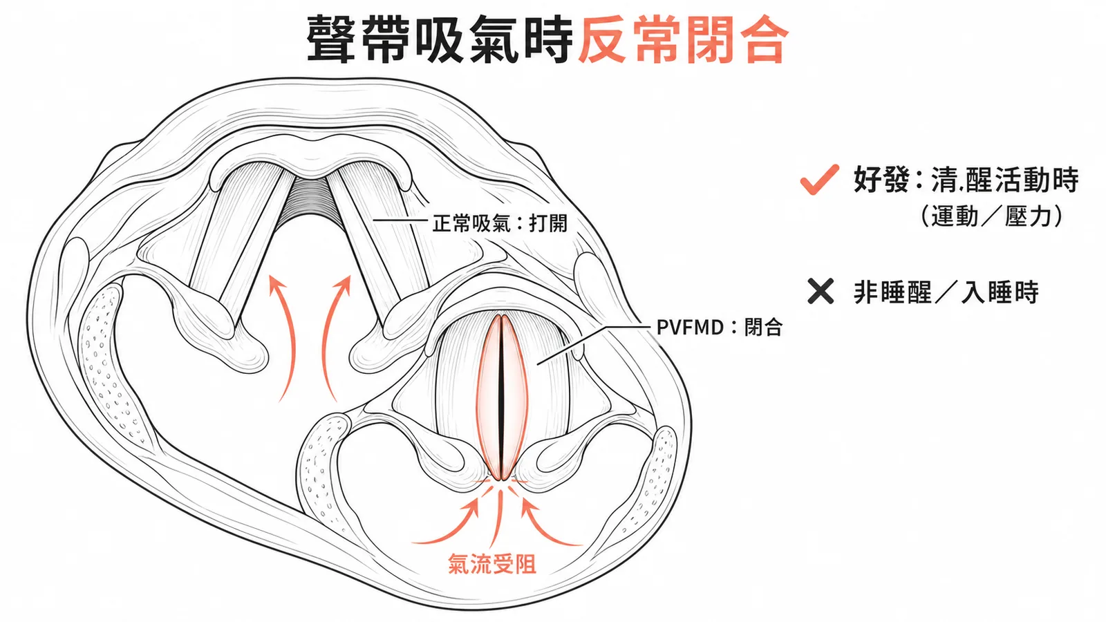 反常性聲帶運動障礙在清醒活動時發生而非睡眠中