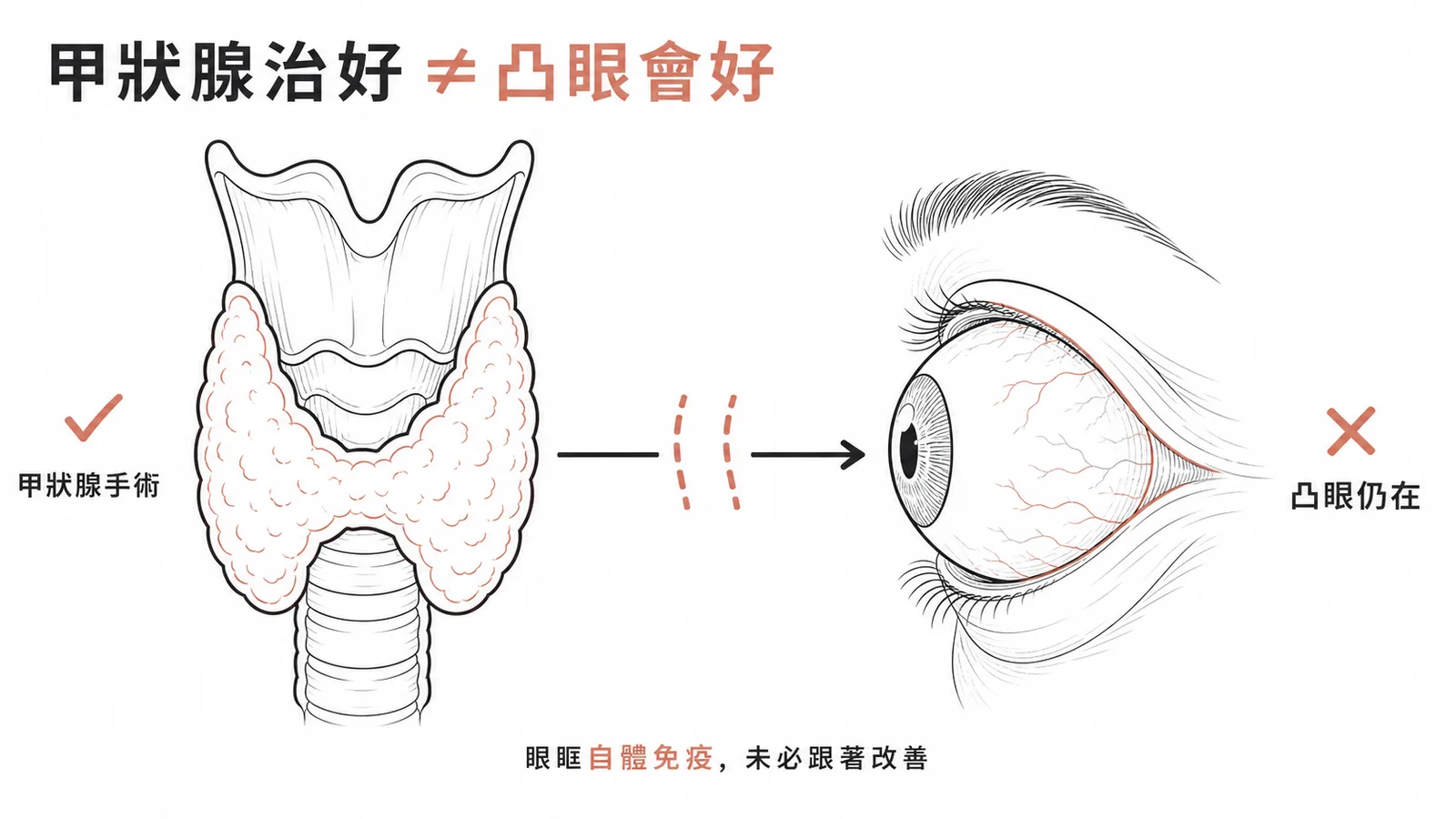 Graves 眼病變與甲狀腺治療無直接連動示意圖