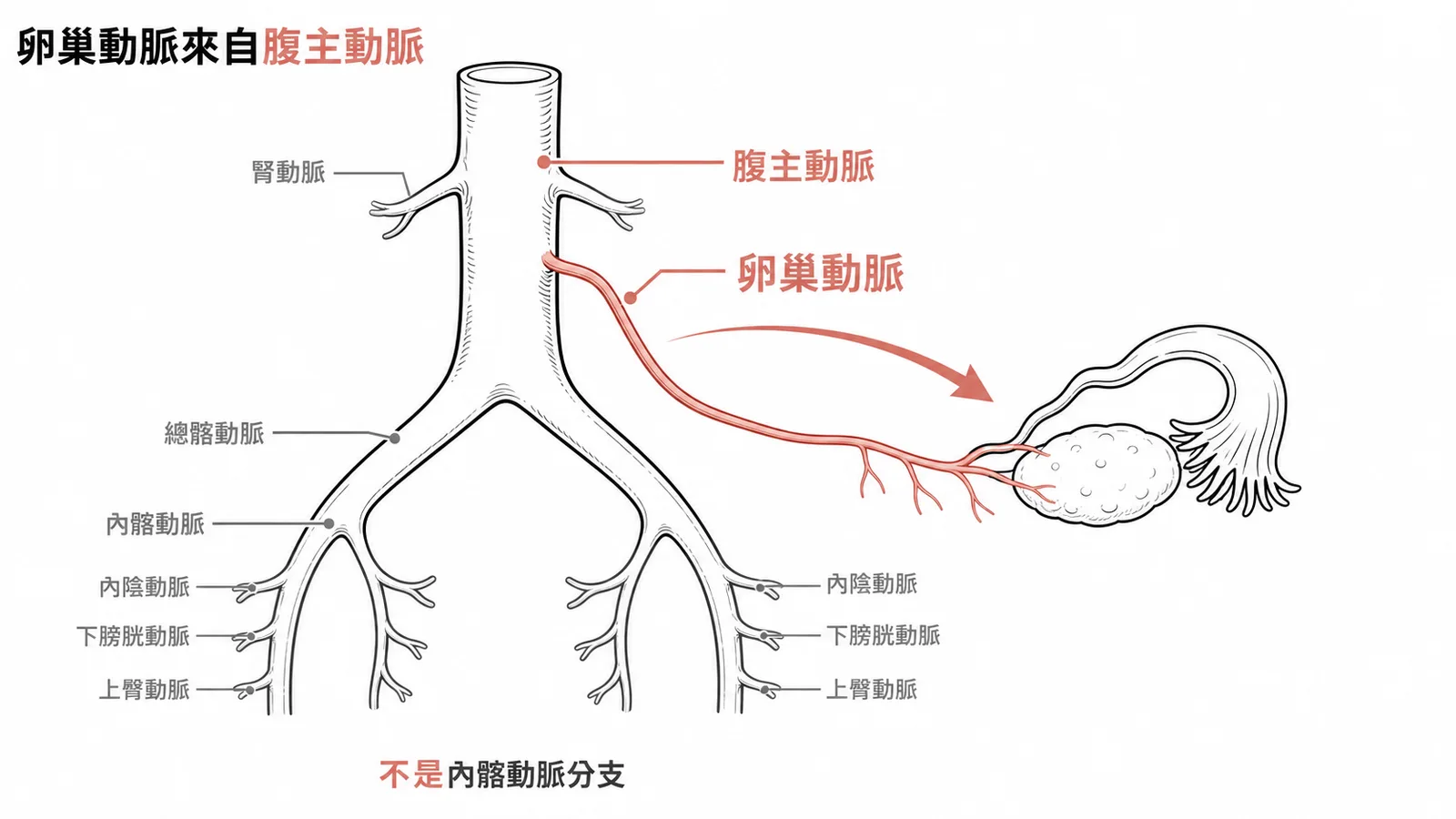 卵巢動脈直接從腹主動脈分出而非內髂動脈示意圖