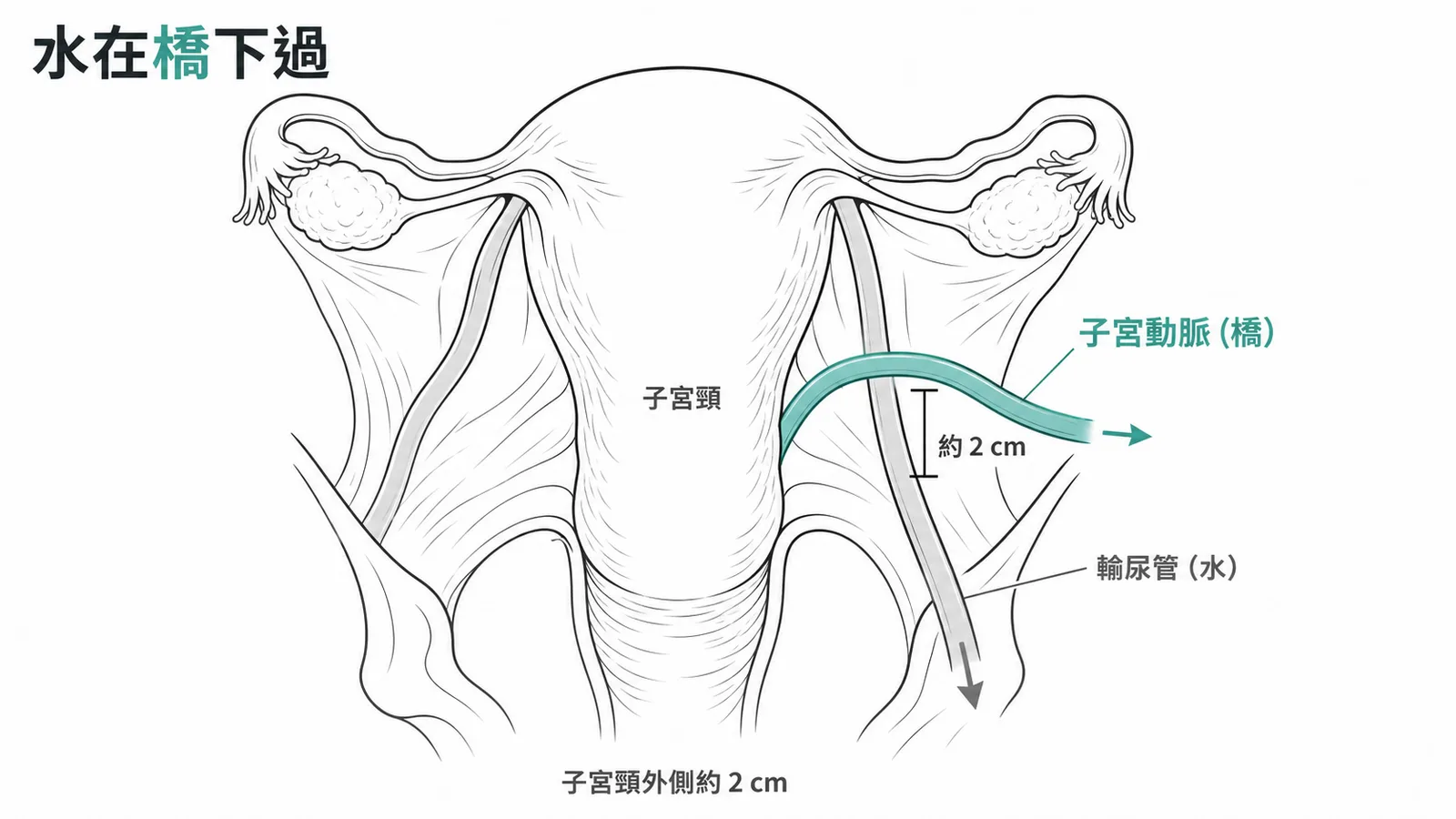 子宮動脈在子宮頸外側約 2 cm 處跨越輸尿管示意圖