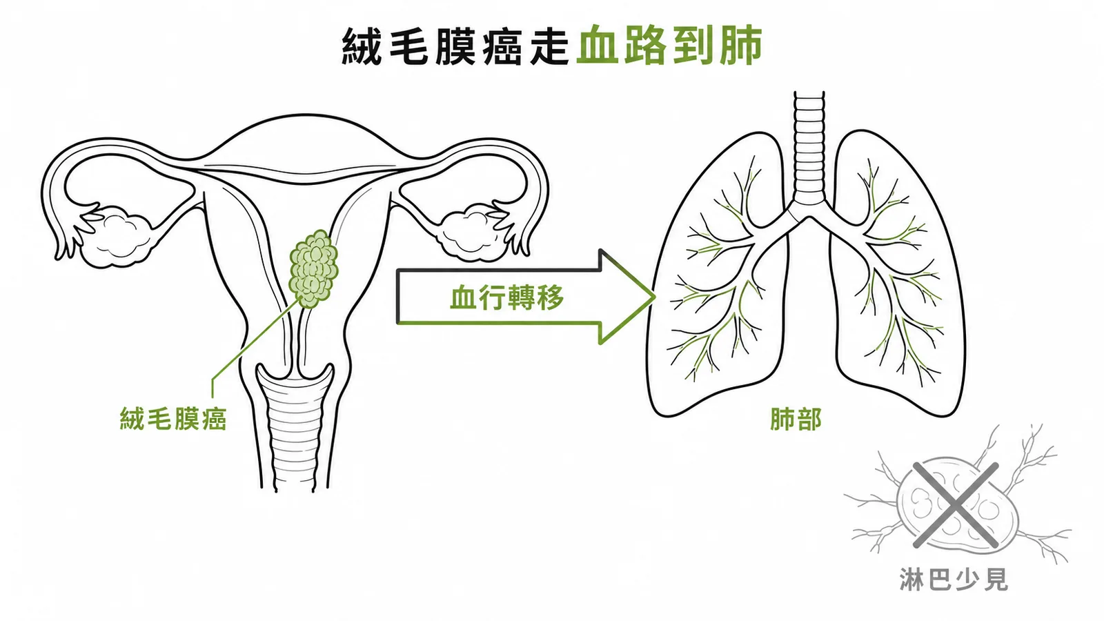 絨毛膜癌主要經血行轉移至肺部示意圖