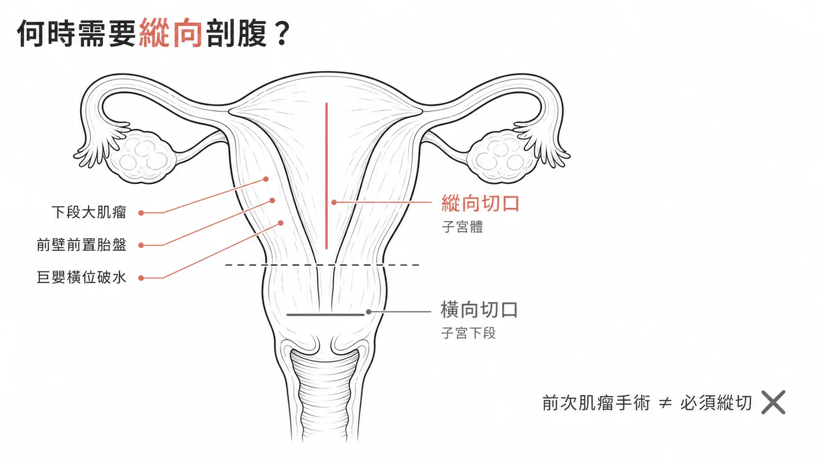 剖腹產縱向與橫向子宮切開適應症對照示意圖