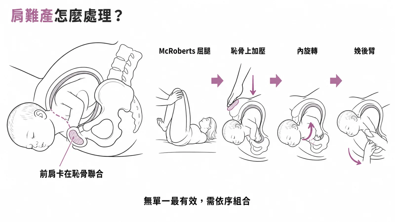 肩難產 HELPERR 處理流程示意圖