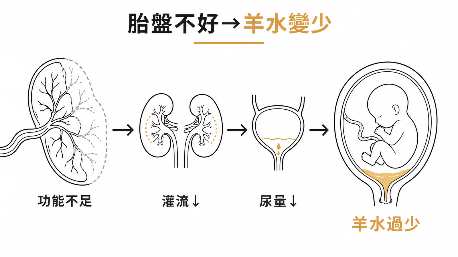 胎盤功能不足導致胎兒尿量減少造成羊水過少示意圖