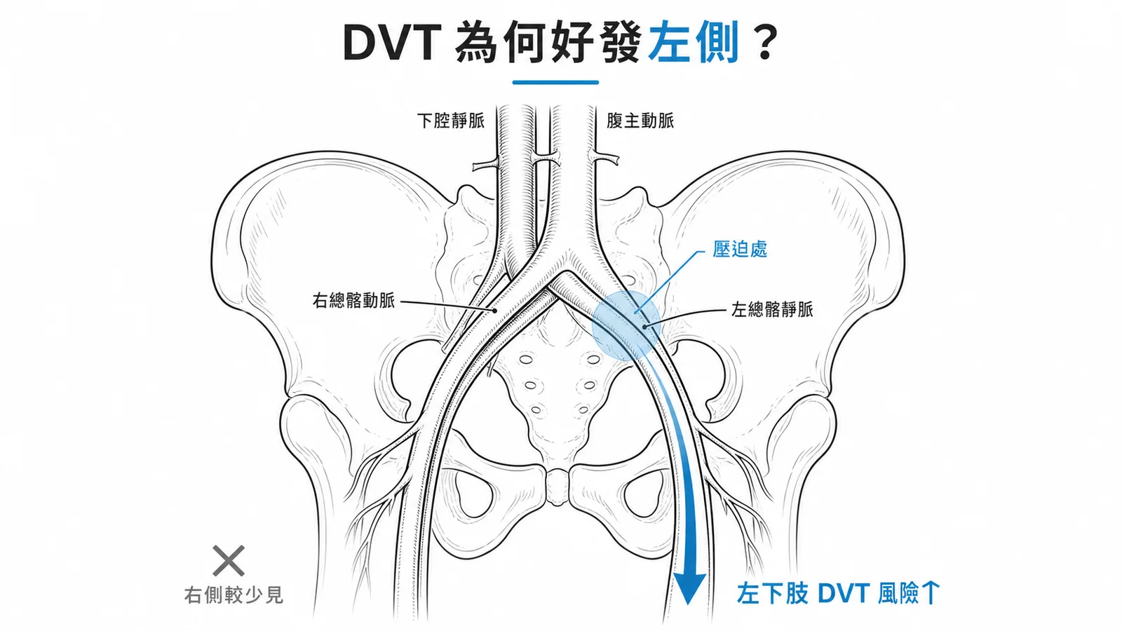 May-Thurner 症候群左髂總靜脈被右髂總動脈壓迫導致左下肢 DVT 示意圖
