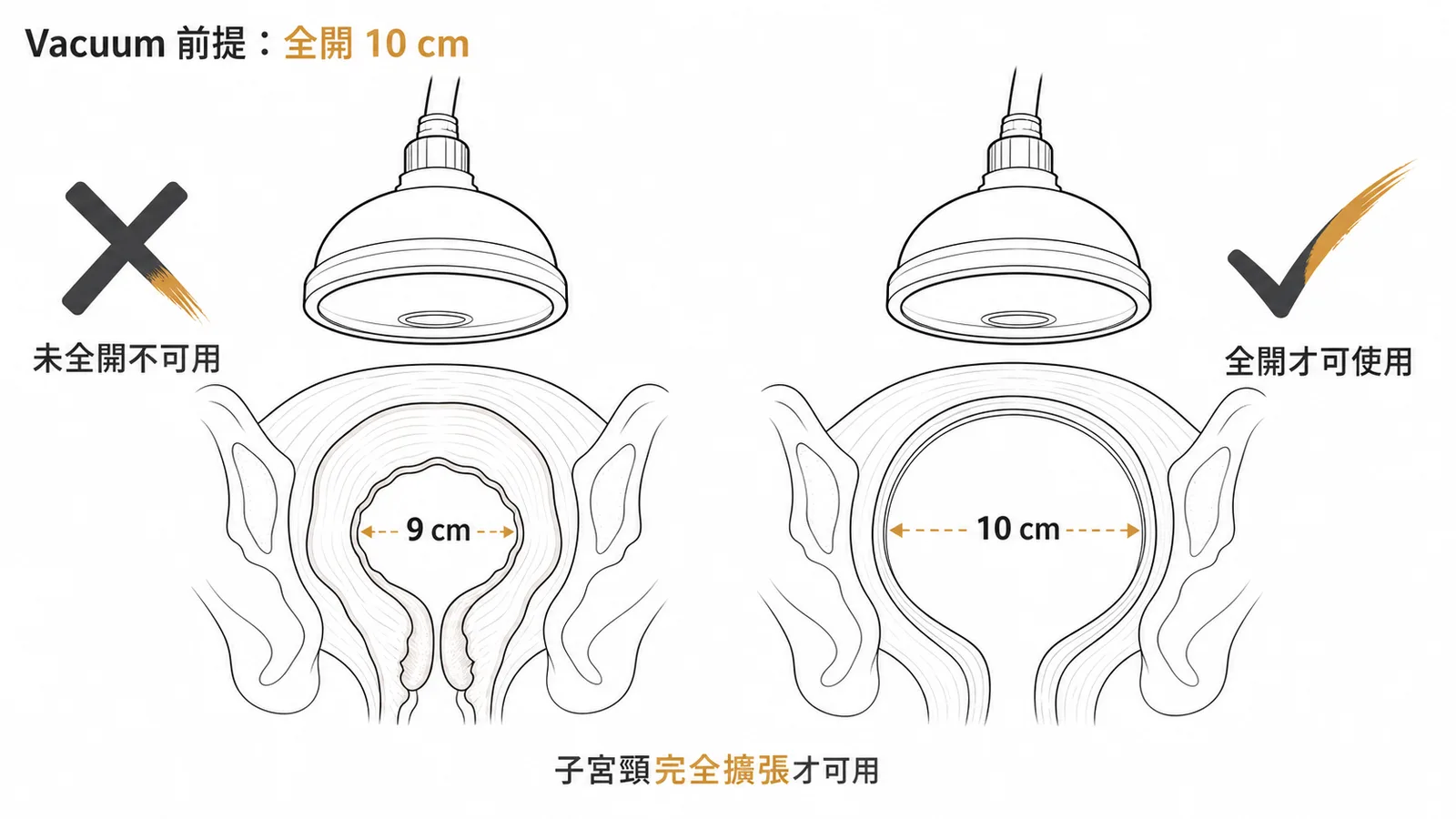 真空吸引器使用前提為子宮頸全開 10 公分示意圖