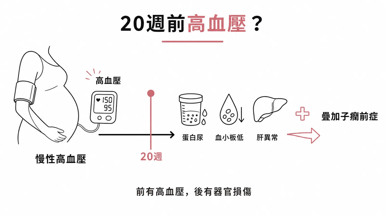 慢性高血壓合併子癇前症的時間分類示意圖
