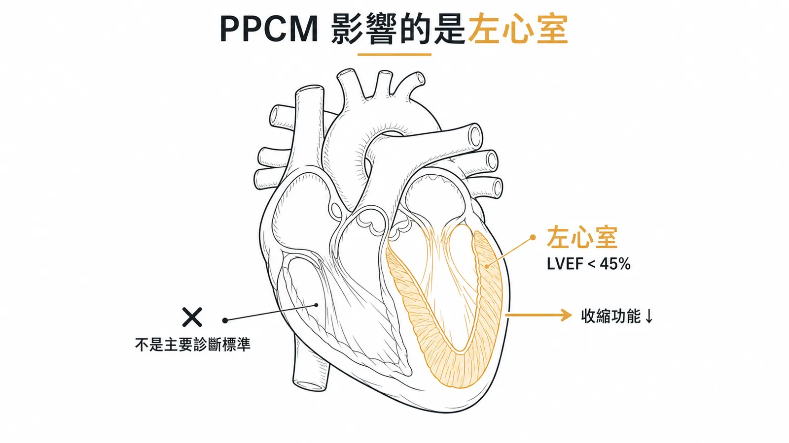 周產期心肌病變診斷標準示意圖