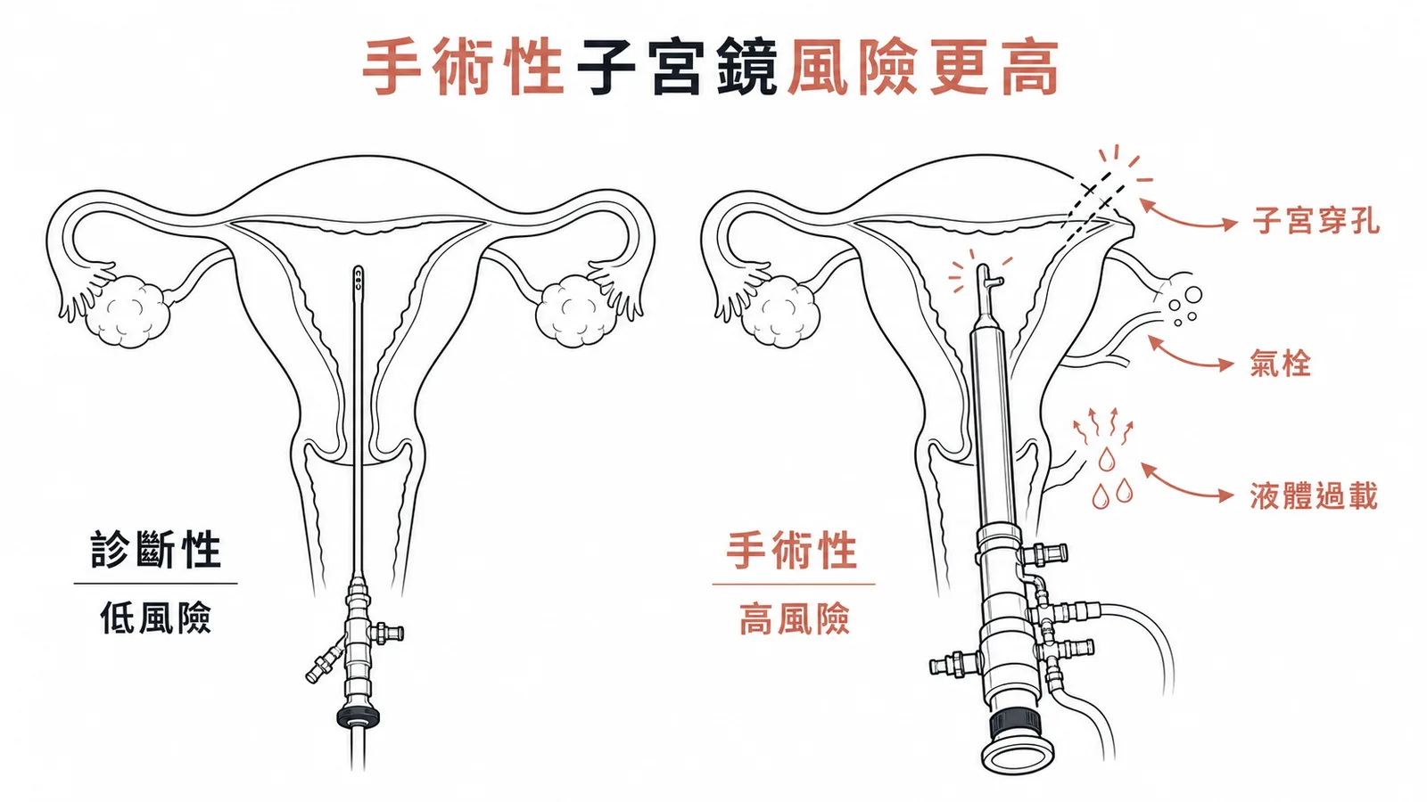 手術性與診斷性子宮鏡併發症風險比較
