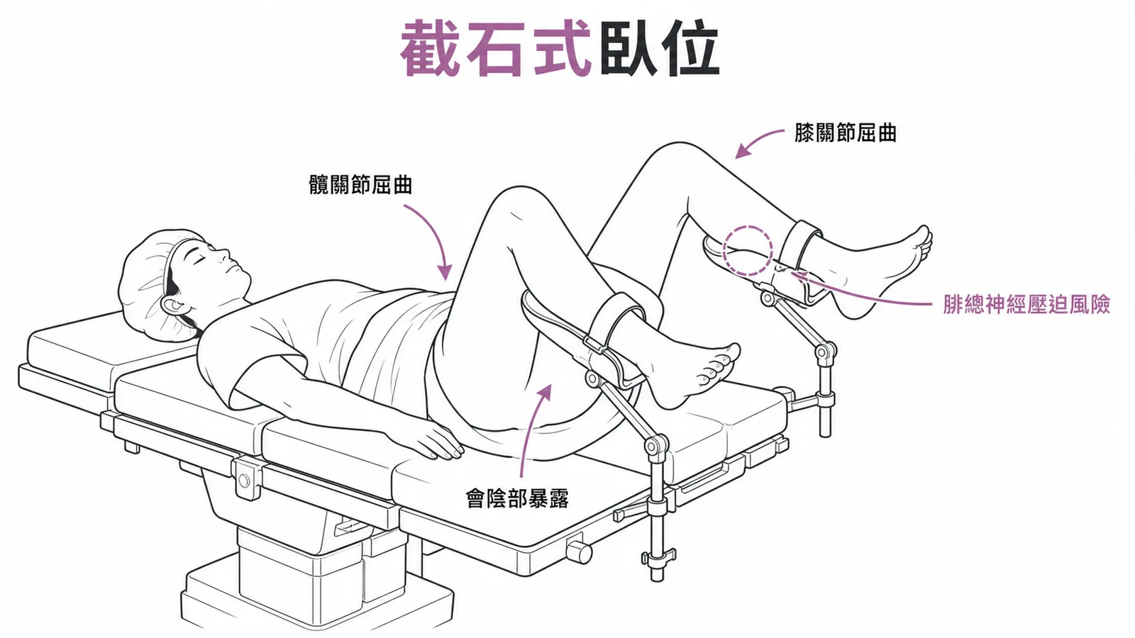 截石式臥位病人姿勢示意圖