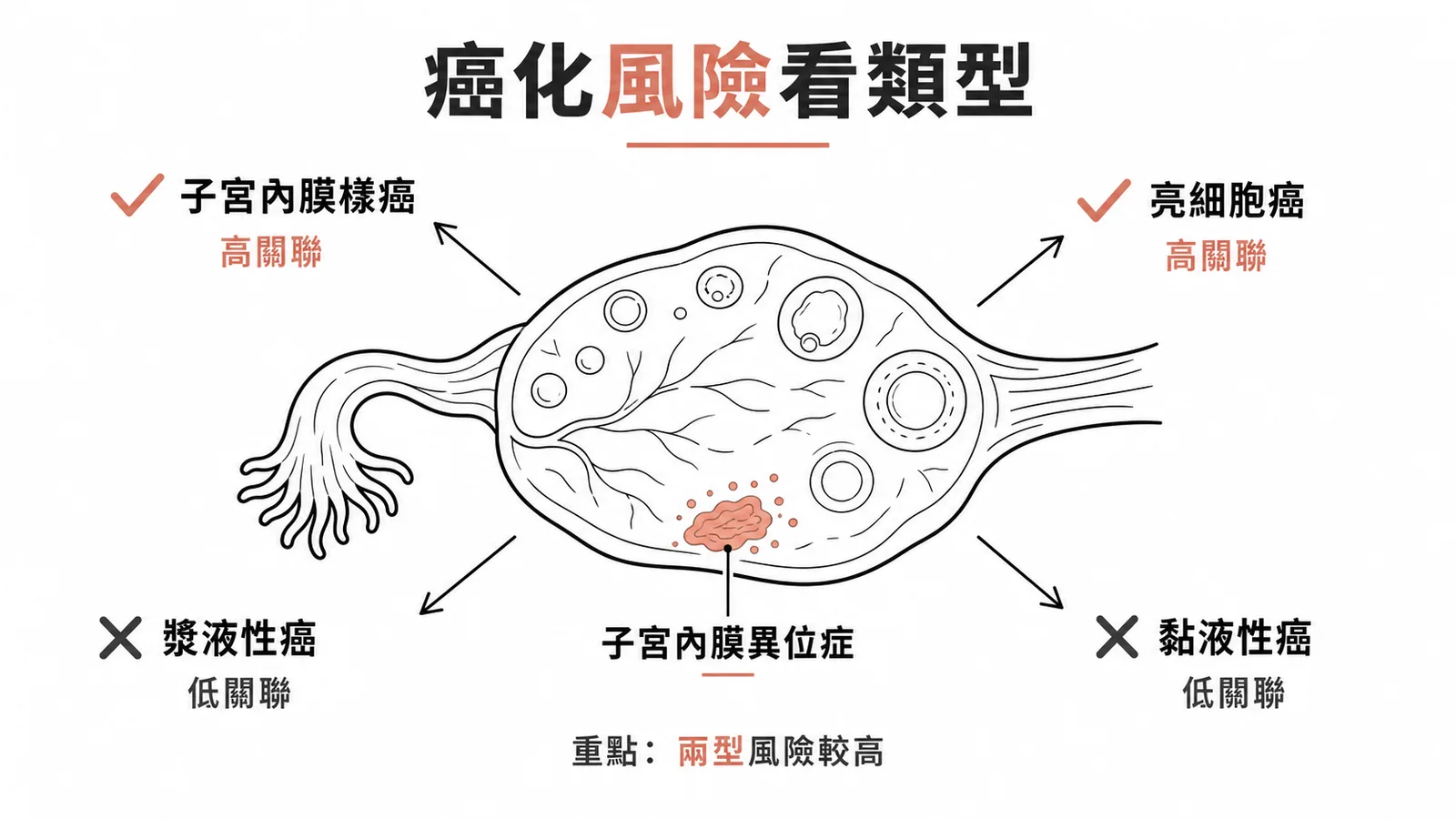 子宮內膜異位症關聯的卵巢癌類型