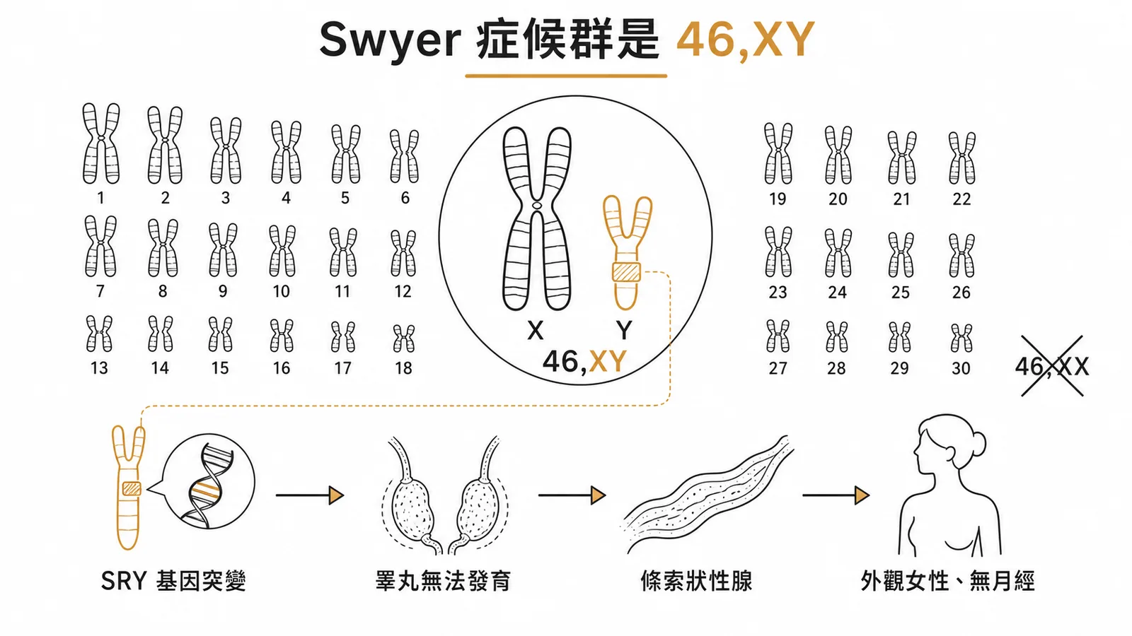 Swyer syndrome 染色體為 46,XY 而非 46,XX