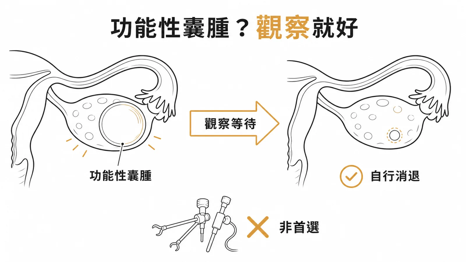 功能性卵巢囊腫以觀察為主而非手術