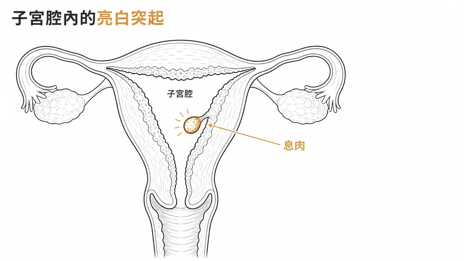 子宮內膜息肉在超音波下呈子宮腔內亮白色突起團塊