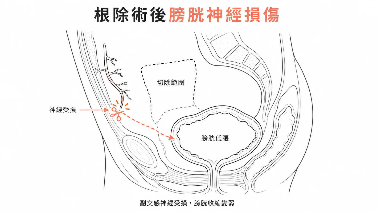 子宮根除術最常見慢性併發症為膀胱低張症