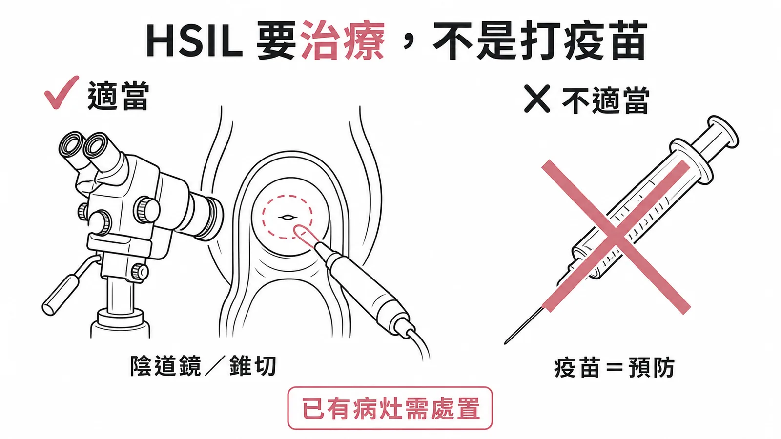 HSIL需陰道鏡切片或錐切治療,疫苗無法治療現有病灶