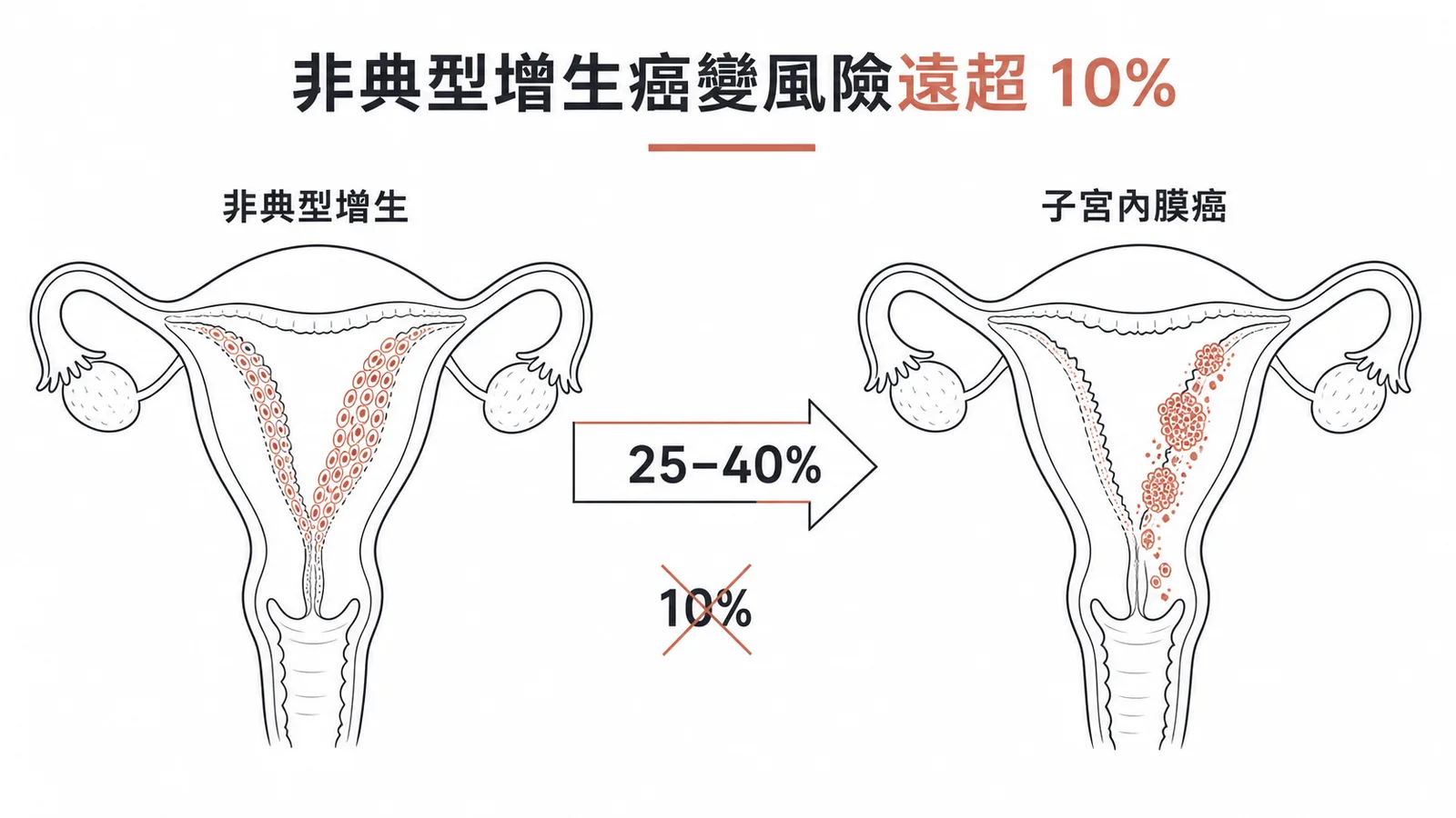 非典型子宮內膜增生合併內膜癌機率約25-40%,遠高於10%