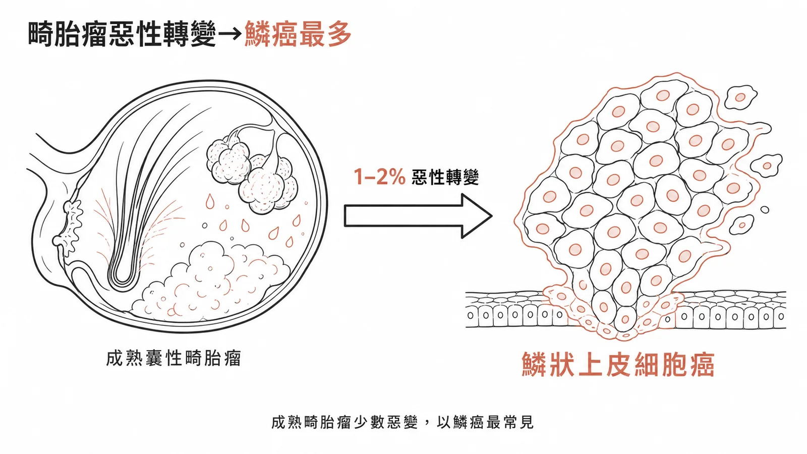 成熟囊性畸胎瘤惡性轉變最常見為鱗狀上皮細胞癌