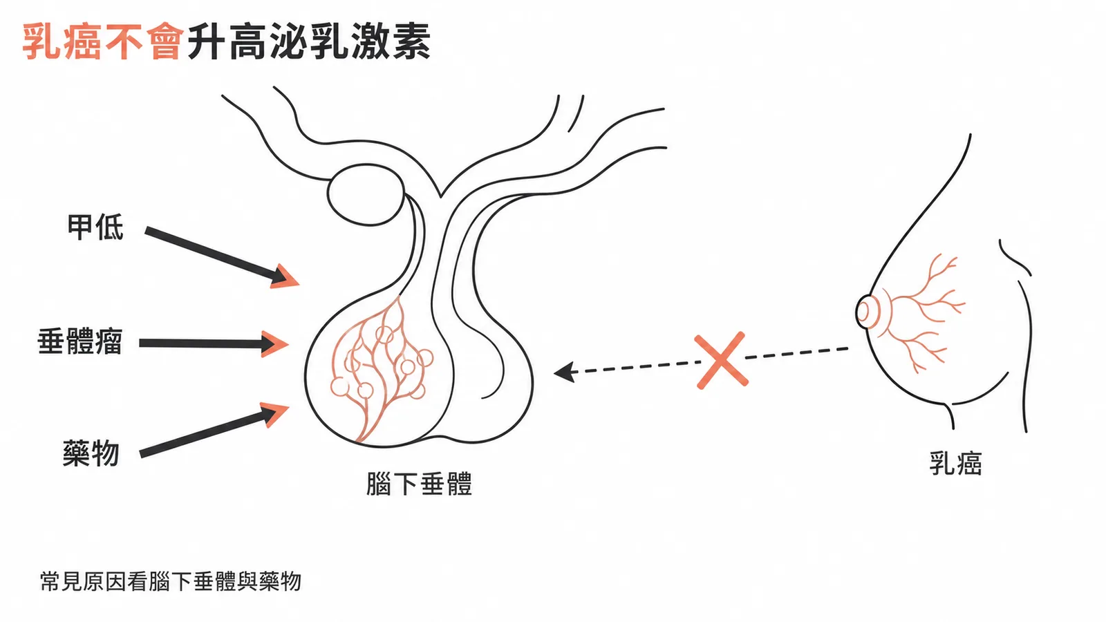 泌乳激素升高的常見原因包括甲低、垂體瘤、藥物,乳腺癌不是