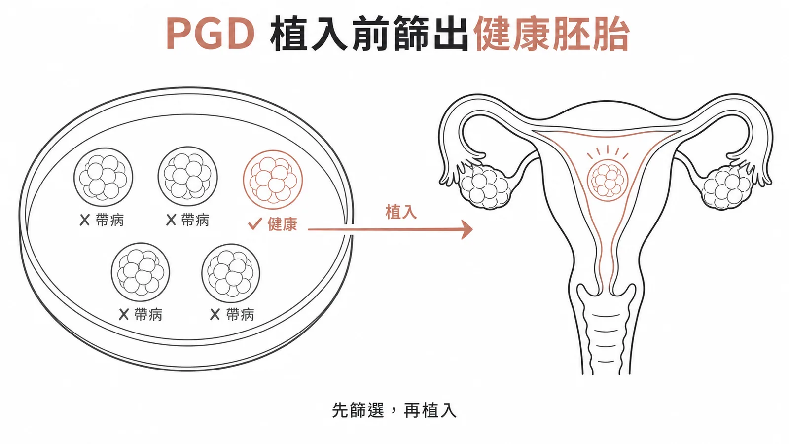 IVF加PGD可在植入前篩選健康胚胎,避免終止妊娠