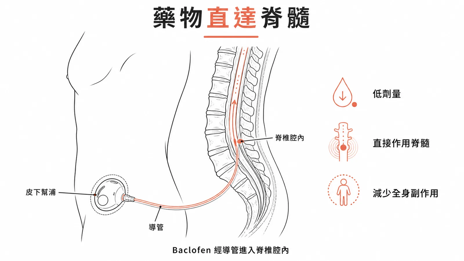Baclofen 經脊椎腔內幫浦直接作用於脊髓,低劑量即可有效降低痙攣