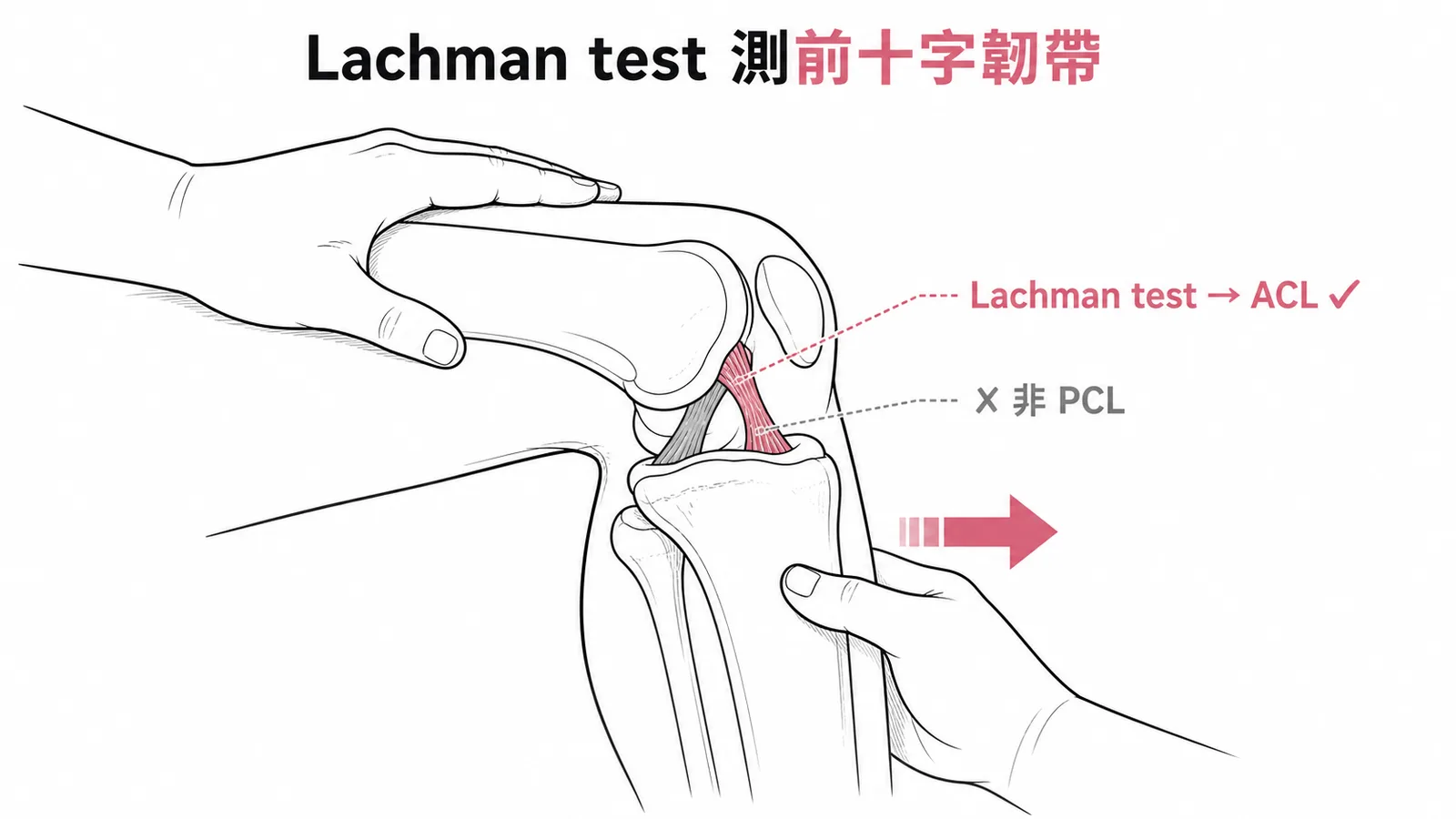 Lachman test 是診斷前十字韌帶 ACL 損傷的檢查,不是用於後十字韌帶 PCL