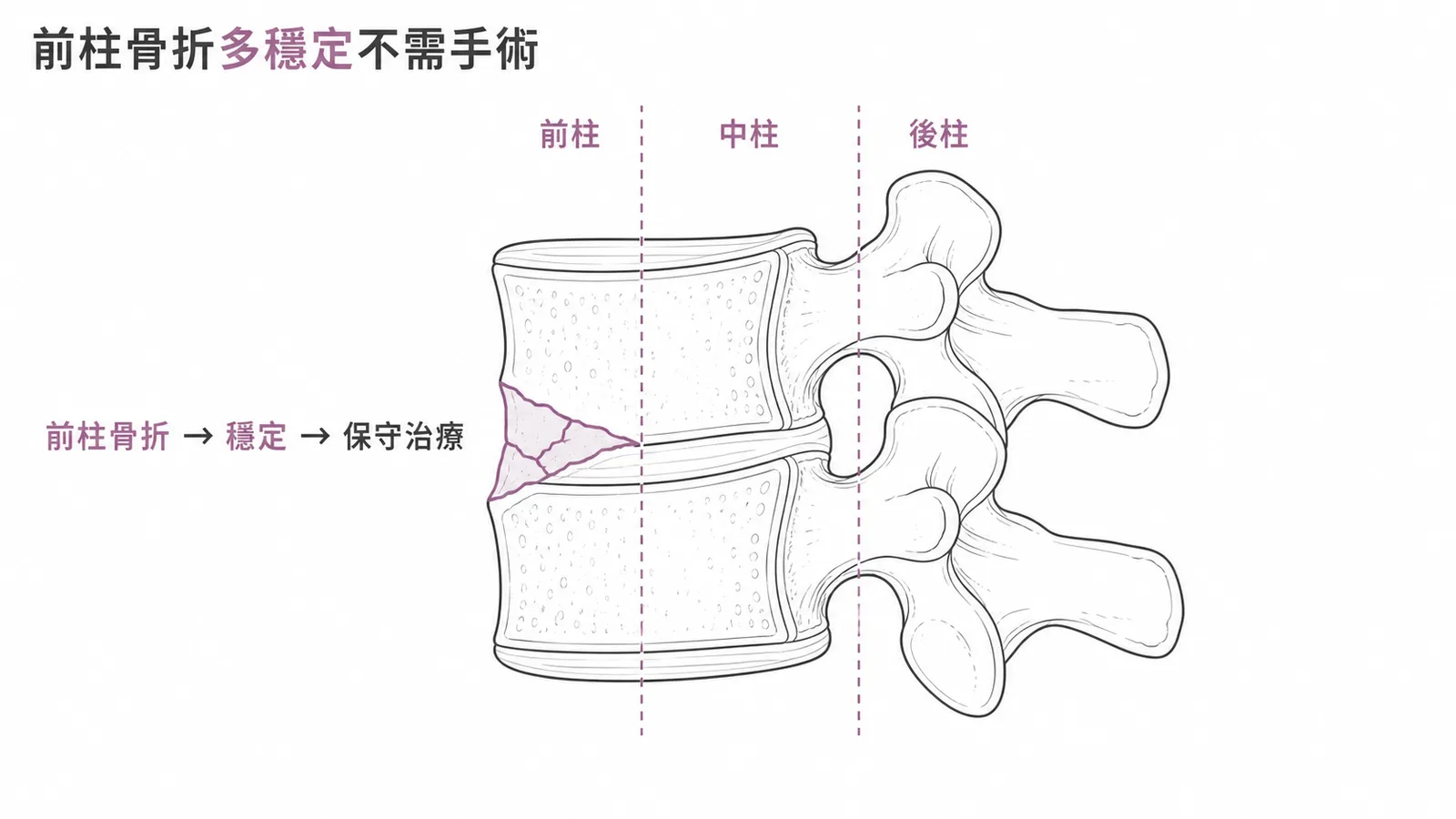 骨質疏鬆壓迫性骨折通常只涉及脊椎前柱,屬穩定性骨折,保守治療為主