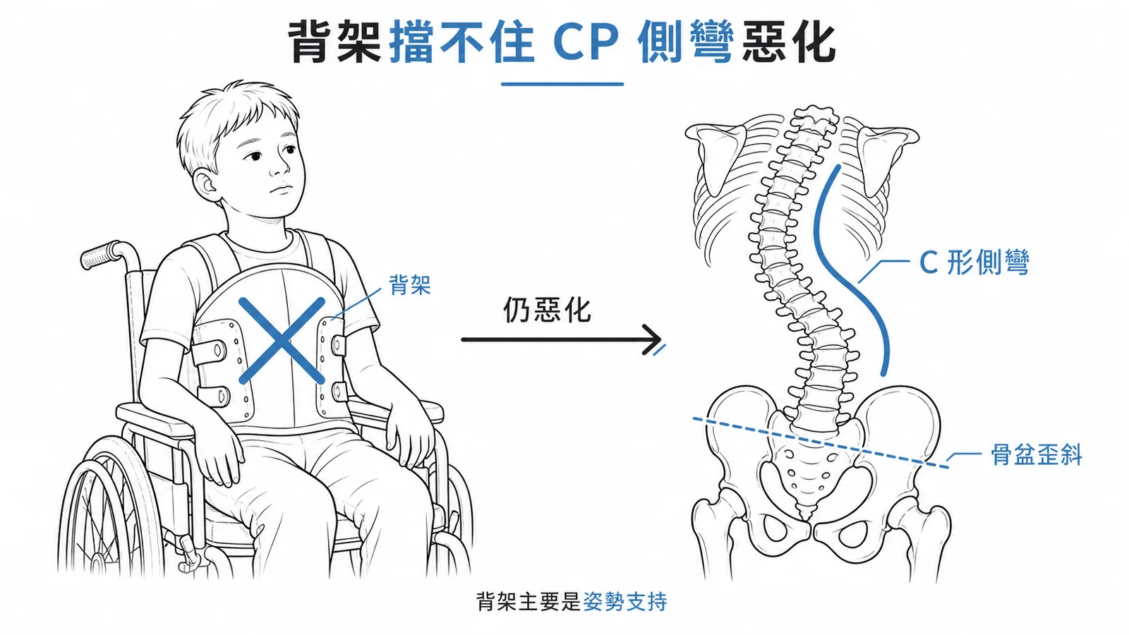 腦性麻痺脊椎側彎:背架無法有效阻止惡化
