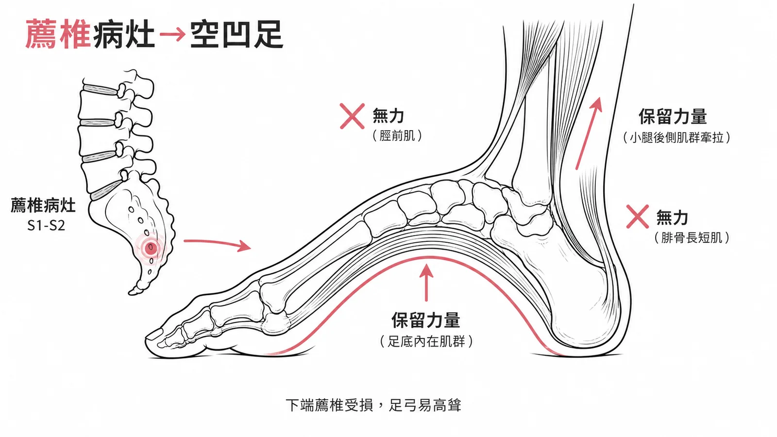 薦椎病灶導致足部肌肉失衡形成空凹足