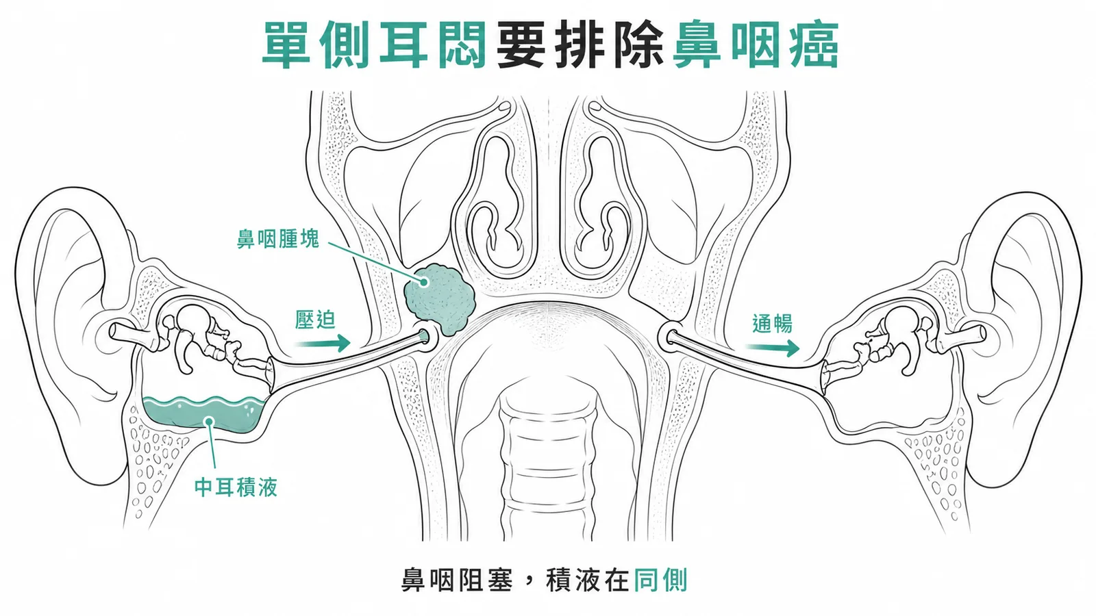 鼻咽部腫塊壓迫耳咽管導致中耳積液——鼻咽癌典型表現