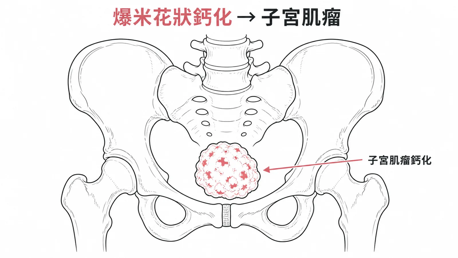 骨盆腔爆米花狀鈣化團塊為子宮肌瘤鈣化典型影像