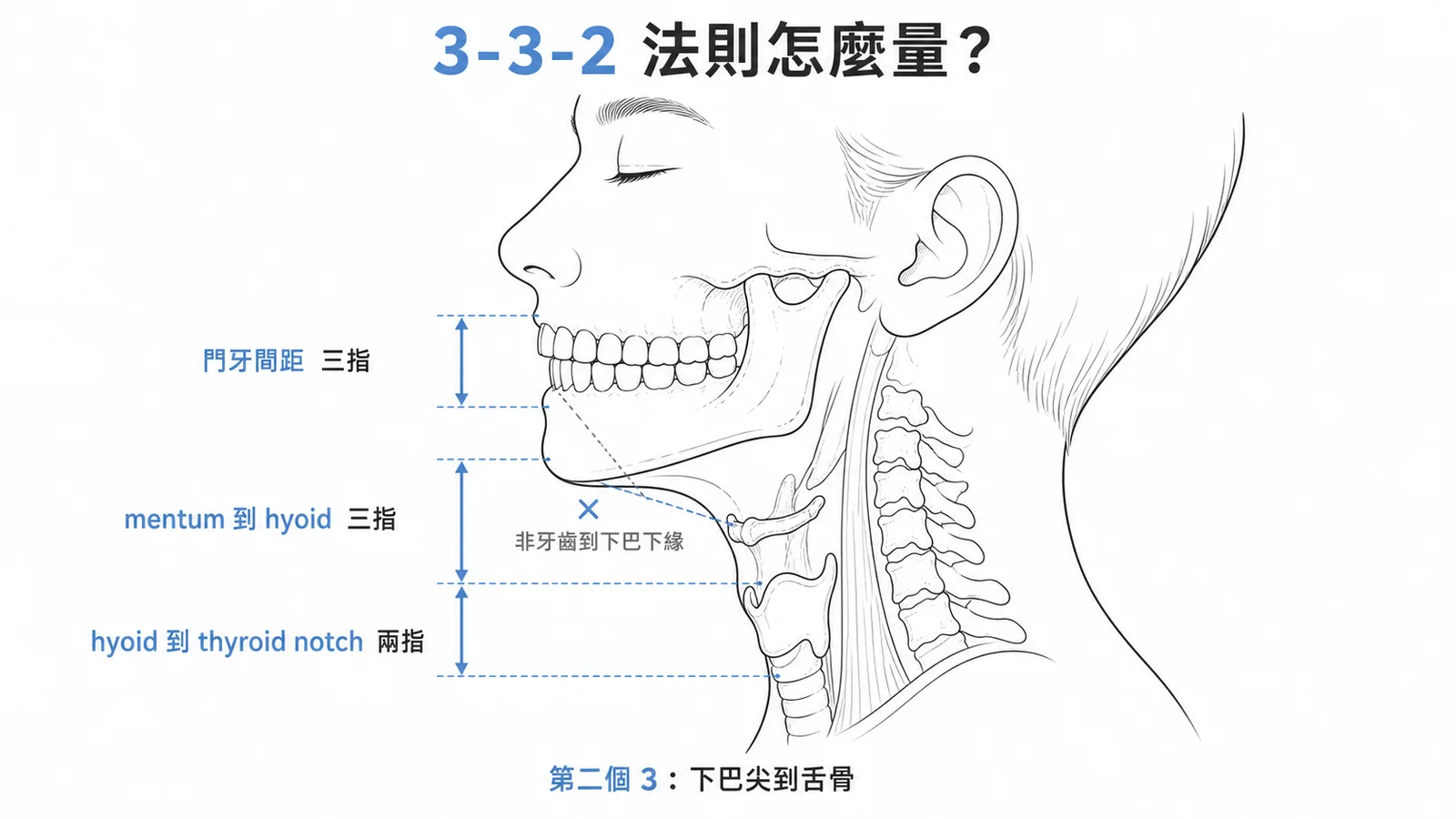 LEMON 3-3-2 法則:門牙間距三指、mentum 到 hyoid 三指、hyoid 到 thyroid notch 兩指