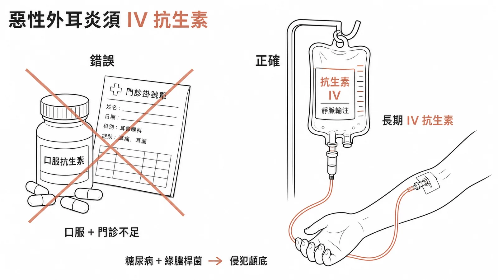 惡性外耳炎需靜脈抗生素治療,口服抗生素不足以控制