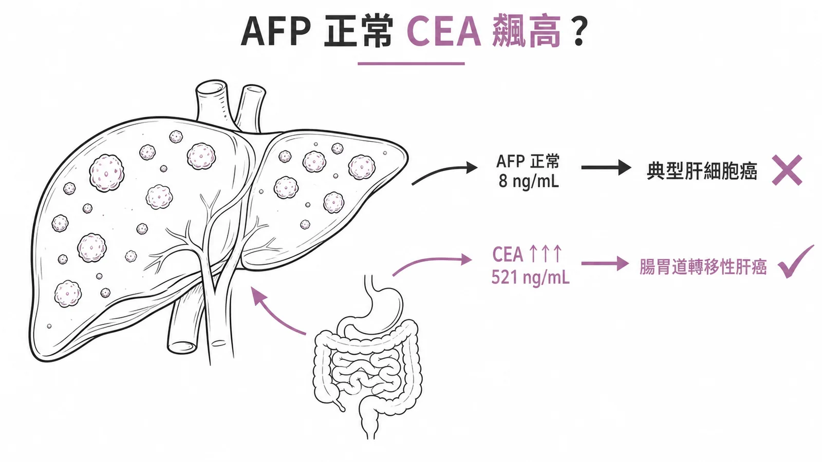 肝臟腫瘤標記鑑別:AFP正常排除典型肝細胞癌,CEA飆高521指向腸胃道轉移性肝癌