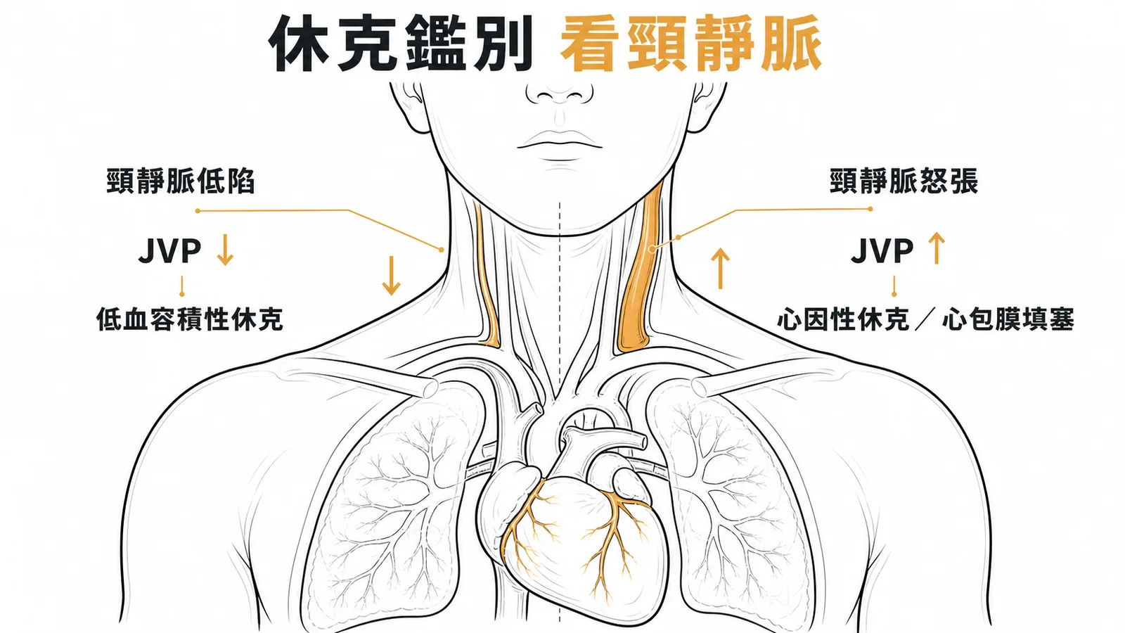 休克鑑別看頸靜脈:JVP低陷指向低血容積性休克,JVP怒張指向心因性休克或心包膜填塞