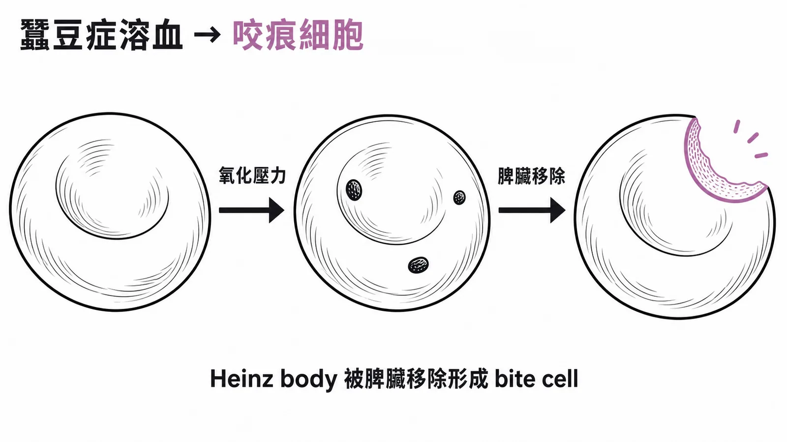 G6PD 缺乏症溶血形成咬痕細胞 bite cell 的機轉示意圖
