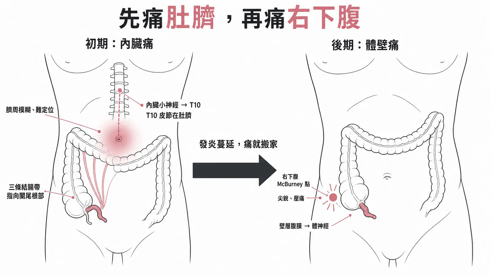 闌尾炎轉位痛示意圖：初期是內臟痛，走內臟小神經進 T10 脊髓節段，T10 皮節在肚臍，所以痛在臍周且模糊難定位；發炎蔓延到壁層腹膜後改由體神經（肋間神經）傳導，痛搬家到右下腹 McBurney 點、變成尖銳的壓痛。圖中並標出三條結腸帶匯聚指向闌尾根部