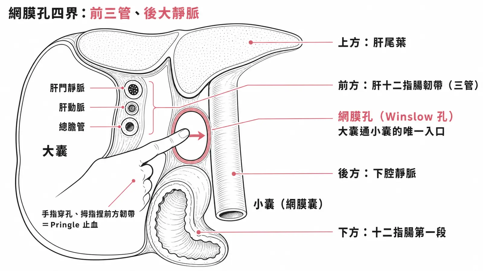 網膜孔（Winslow 孔）四個邊界示意圖：前方是肝十二指腸韌帶（內含肝門靜脈、肝動脈、總膽管三管），後方是下腔靜脈，上方是肝尾葉，下方是十二指腸第一段；手指穿過網膜孔、拇指捏住前方韌帶即 Pringle 止血手法