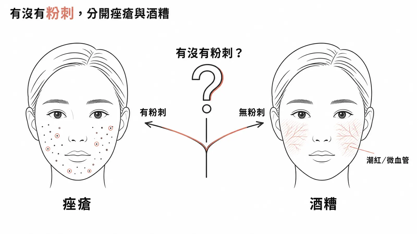 有無粉刺分流：有粉刺為痤瘡，無粉刺潮紅為酒糟