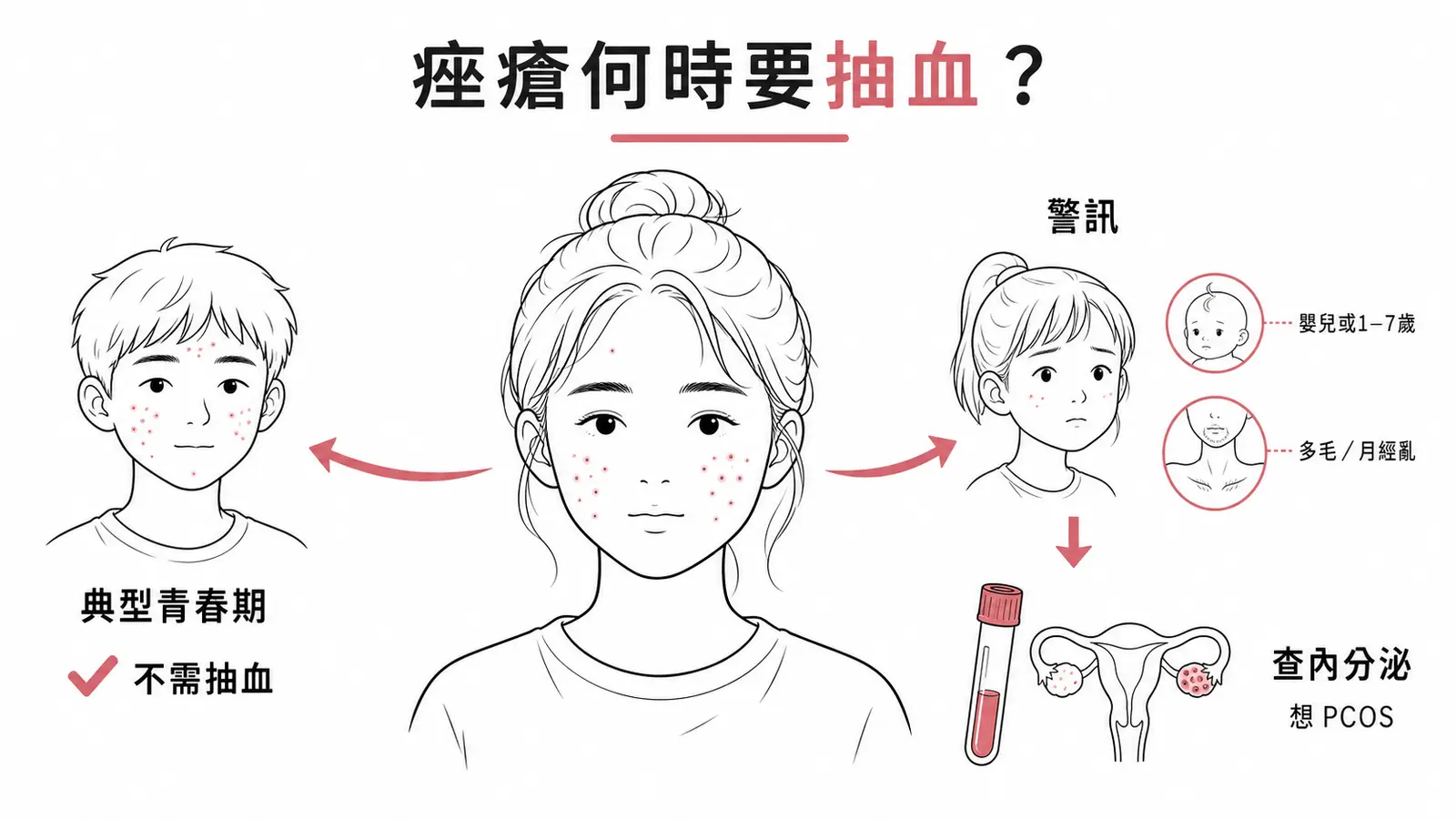 痤瘡何時要查內分泌：典型青春期不抽血，年齡不對或雄性素過多才進一步查因