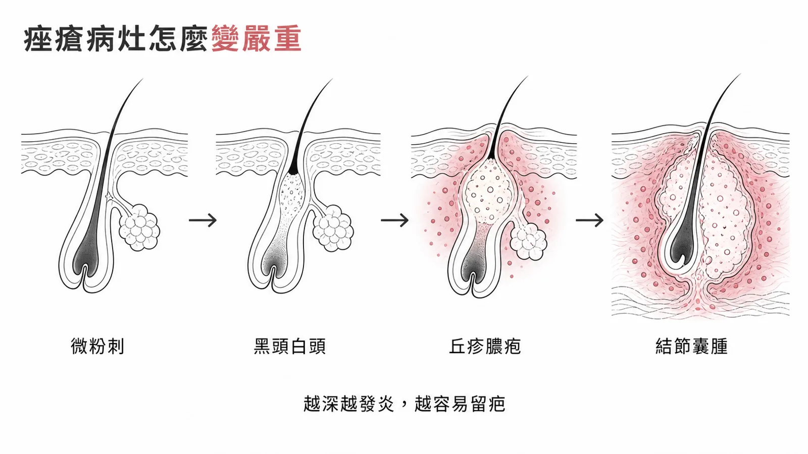 痤瘡病灶進程：微粉刺到黑頭白頭粉刺，再到丘疹膿疱與結節囊腫