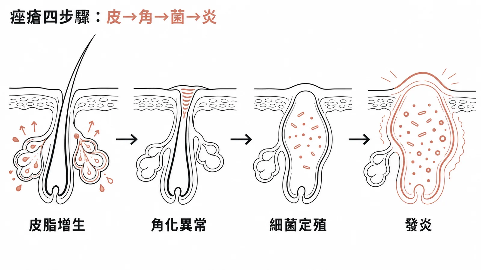 痤瘡四大致病機轉箭頭串接：皮脂腺增生、毛囊角化異常、C. acnes 定殖、發炎反應