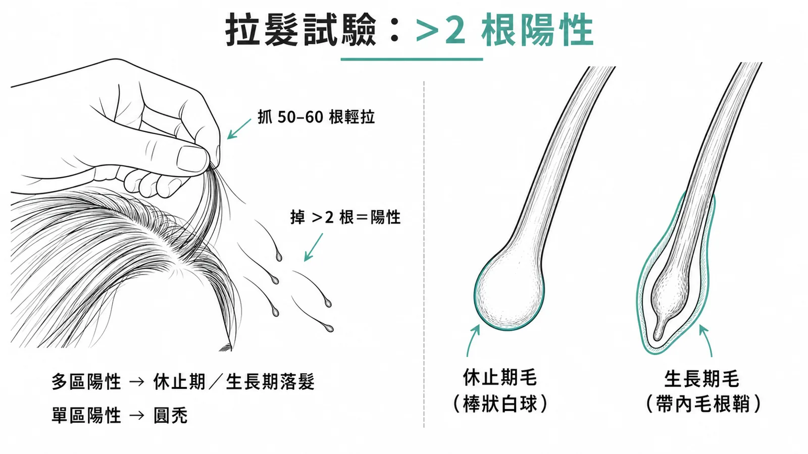 拉髮試驗與毛髮鏡檢：抓 50-60 根輕拉、掉超過 2 根為陽性，多區陽性偏向休止期或生長期落髮、單區陽性偏向圓禿；休止期毛是棒狀白色毛球、生長期毛帶著內毛根鞘