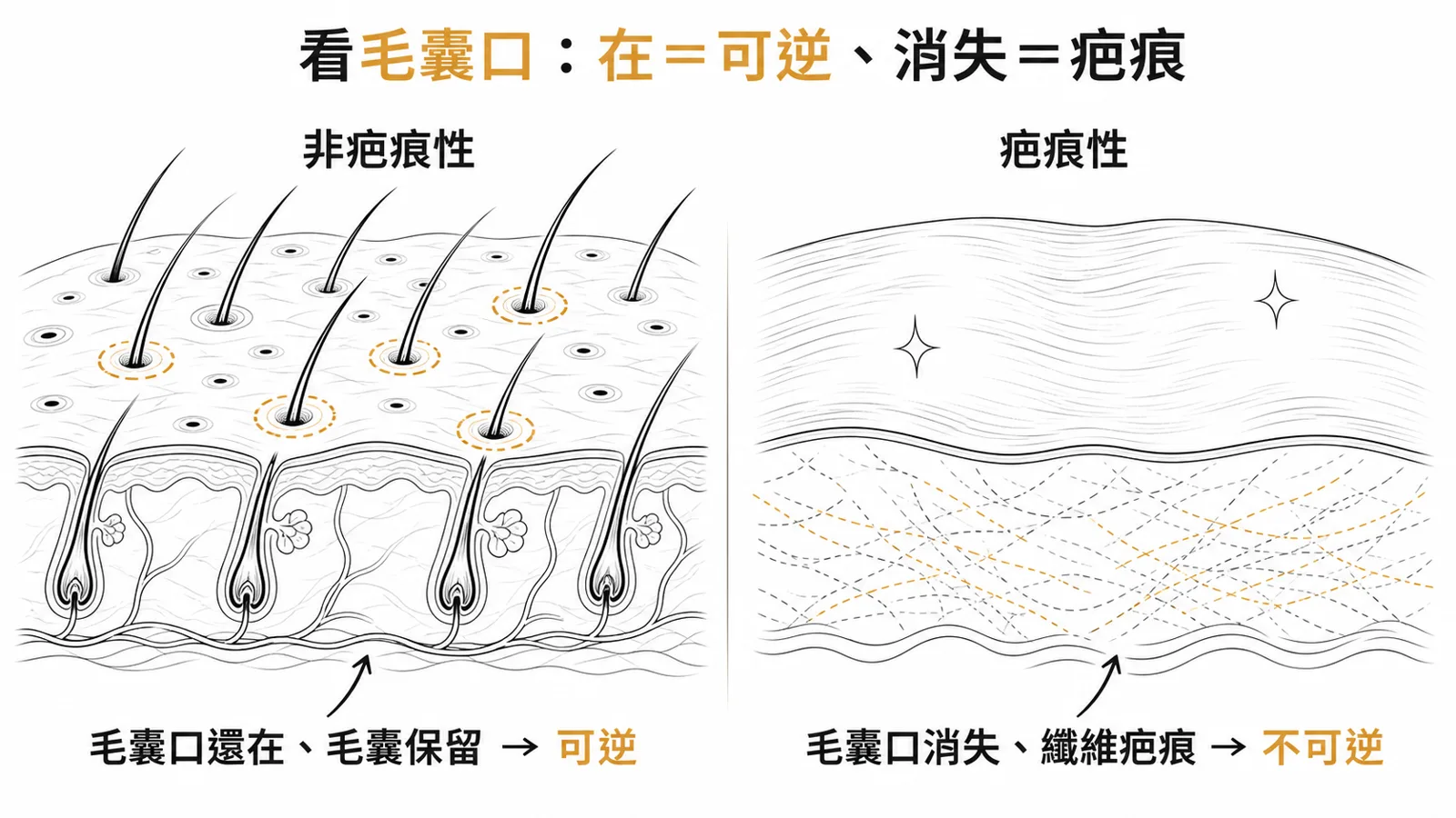 疤痕性與非疤痕性落髮的關鍵區分：非疤痕性頭皮還看得到毛囊口（毛孔）、毛囊保留、可逆；疤痕性頭皮平滑、毛囊口消失、毛囊被纖維疤痕取代、不可逆
