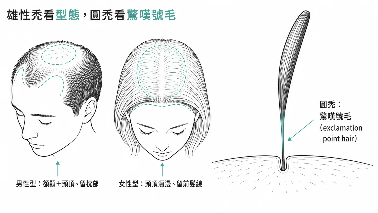 非疤痕性落髮的招牌：雄性禿男性型是額顳與頭頂變薄、保留枕部與顳側緣，女性型是頭頂瀰漫變薄、保留前髮線；圓禿可見驚嘆號毛（髮幹往頭皮端變細）